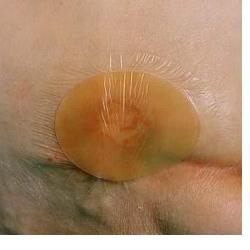 MEDICAZIONE IDROCOLLOIDALE TEGADERM HYDROCOLLOID THIN QUADRATA SENZA BORDO 10X10CM 5 PEZZI - Farmadillo